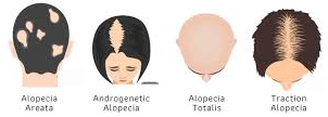 alopecia